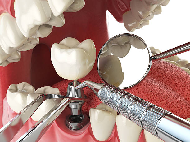 Best Emergency Root Canal Therapy in Ocoee, FL